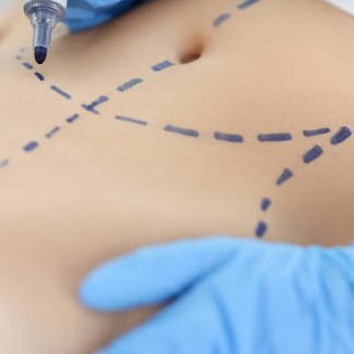 liposuction in riyadh