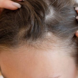 Hair Loss Treatment  In Riyadh